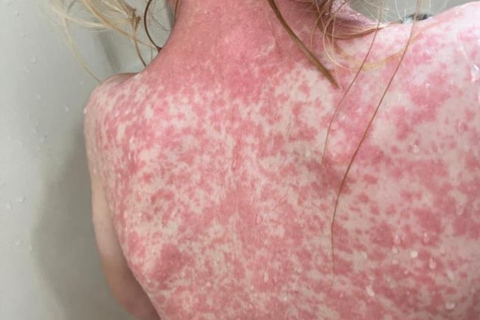 📰 Alerta Sanitaria en Arandas: Confirman Casos de Sarampión en la&nbsp;Región